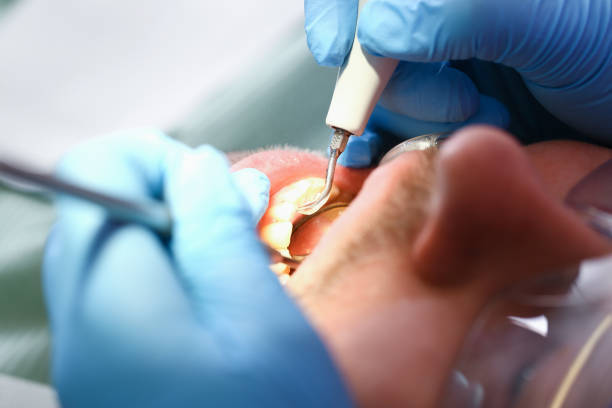 Best Emergency Wisdom Tooth Extraction in Vineyards, FL